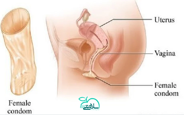 تمام آنچه که باید در خصوص کاندوم زنانه و نحوه استفاده ی آن بدانید